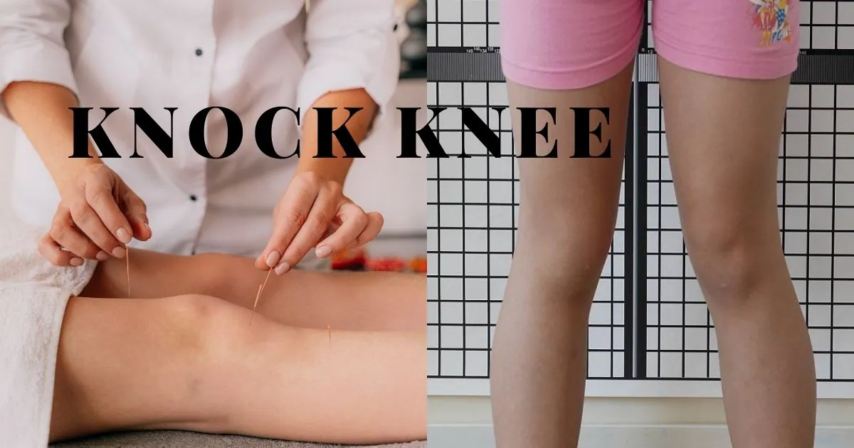 Knock knees causes exercise treatments