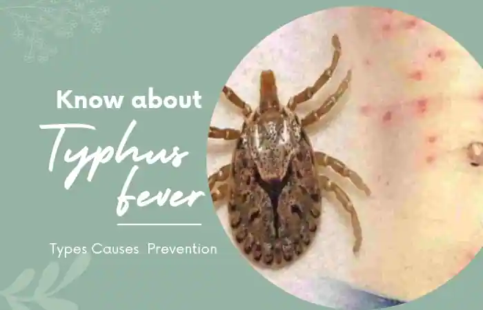 Typhus Fever Causes Types Prevention